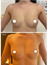 美人バスト 渋谷店/【バストアップ・育乳】症例☆