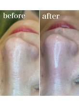 リム(Lim:)/ハイドロ毛穴洗浄◆小顔エステ