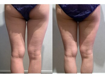 ビーエスアクアビューティー/キャビテーション