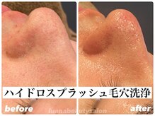 ルアナ(Luana)/【ハイドロ毛穴洗浄】