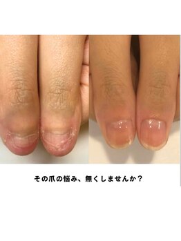ティアラネイル 宇都宮/深爪矯正