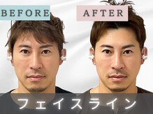 エルシンメトリー矯正院(ailesシンメトリー矯正院)/before＆after　ailes式小顔矯正