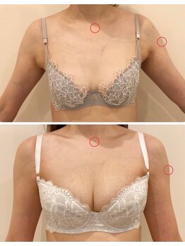 リール 恵比寿店(RIRE)/バストアップ症例【広尾恵比寿】