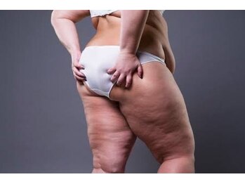 ヨサパーク カフナ(YOSA PARK kafuna)の写真/女性特有のヒップ、太ももまわりの冷え、凸凹脂肪にサヨナラ!!今年こそ気になる下半身を美脚へ☆
