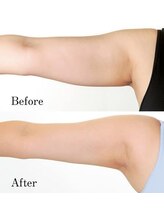 ビマナ 小岩店(NU美Mana)/【脂肪冷却】