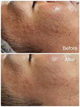 ビーアンドビー(B&B)/ヒト幹細胞コース