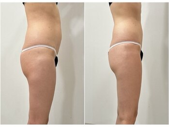 トータルビューティーサロン ナーズ(NAZ)/ハイパーナイフ痩身