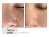 肌管理に最適ツヤハリ◎光フェイシャル　60分　￥6,600→￥5,940