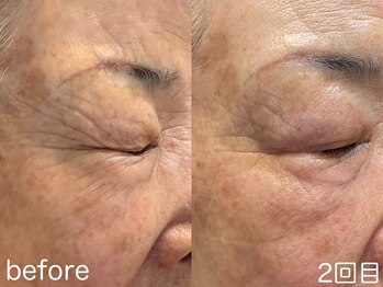 ハレオラ(HaleOla)/80代☆2回目でもしっかり実感!