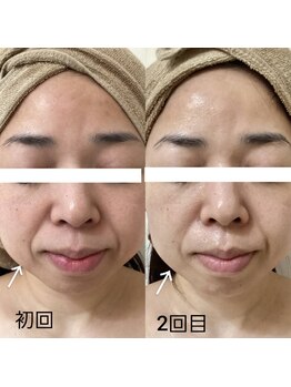 エヌミー(N me)/幹細胞ケアでハリ感が持続◎