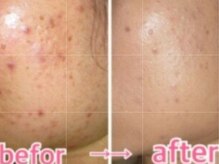 マロン(MARON)/ハーブピーリング