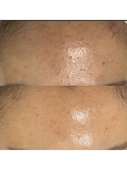 マリヴェリーテ(Mari verite)/毛穴詰まり×ニキビ