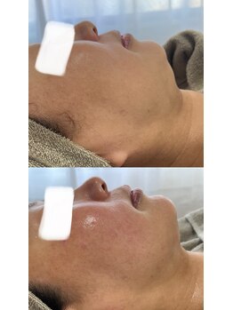 アレイズ(ARAYS)/症例(小顔矯正)