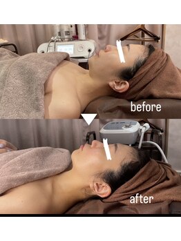 ナルシス(Narcissus)/インディバフェイシャル