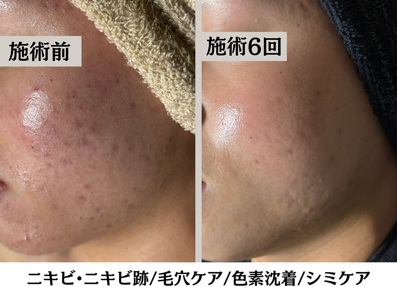 ハーブピーリングHY｜ホットペッパービューティー