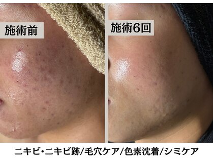 ハーブピーリングHYの写真