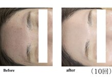 ウィズマツオカ 光の森店/韓国式毛穴洗浄＋漢方美肌