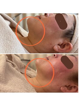 ランティル(l’until)/【フェイスライン・アゴの下】