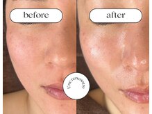 ユヌランコント 岐阜店(Une rencontre)/ハーブピーリング