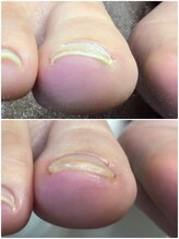 モアクリスタル(More Crystal)/巻き爪補正