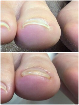 モアクリスタル(More Crystal)/巻き爪補正