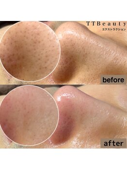 ティーティービューティ 名古屋金山店(TTBeauty)/毛穴エクストラクション