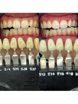 トウキョースワーズ 渋谷店(TOKYO SWRS)/#ホワイトニング #渋谷 #池袋