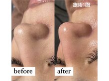 ウィズティ 沖縄市店(with.T)/毛穴集中コース