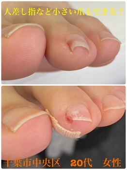 巻き爪じゅん 千葉駅前店/小さい巻き爪も出来ますか？
