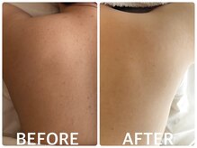 ハーブピーリング 心斎橋/背中ニキビ改善