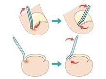 痛みが少ない矯正方法で、他のプレートと比べて11倍の矯正力あり
