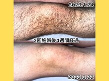 エクレ 柏店(EKURE)/メンズ脚脱毛