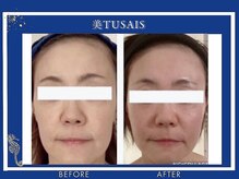 ビテュセ(美Tu sais)/小顔症例【小顔／松山／愛媛】