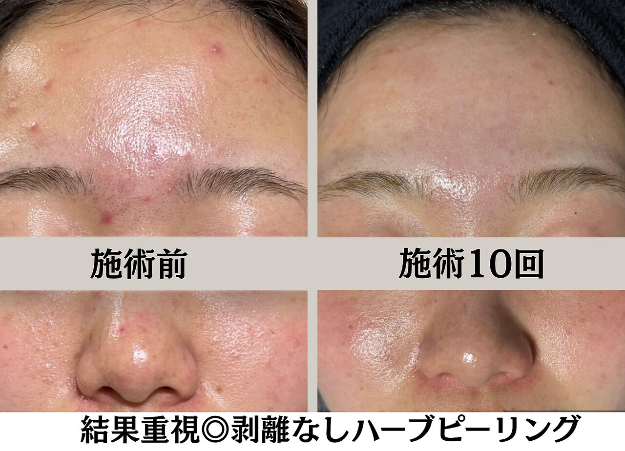 ハーブピーリングHY｜ホットペッパービューティー