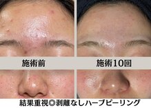 ハーブピーリングHY