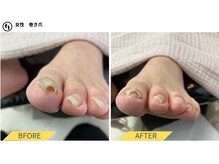 ふっとけ庵/巻き爪ケア