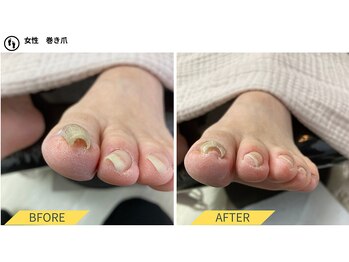 ふっとけ庵/巻き爪ケア