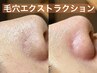 【都度払い】毛穴エクストラクション（鼻のみ）or吸引　50分