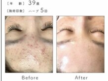 フローレント(Florent)/ハーブピーリング