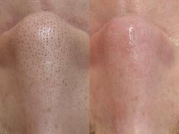 ミュー 栄本店(mieux)/毛穴洗浄でツルツルに