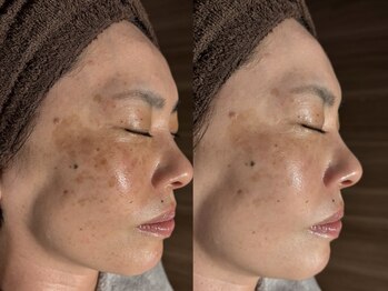 アンティアージュ 福岡本店(antiage)/くすみ・シミしわに効果抜群♪