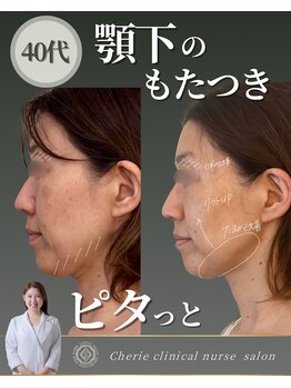 シェリー(Cherie)/40代の小顔/たるみケア