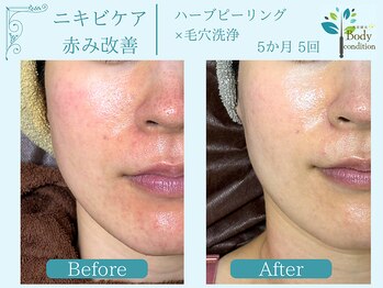 ボディコンディション/ハーブピーリング/毛穴洗浄/小顔