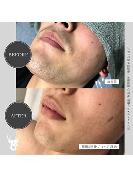 グランズ 芦屋(GLANZ)/男性の濃いヒゲが!