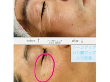 シュエット(Chouette)/ハーブピーリング