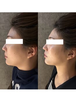 クリアランス 南青山(CLEARANCE)/電気美容鍼+小顔矯正