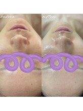 ダオン(Daon)/スタンダード+ハーブピーリング