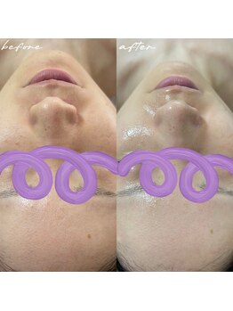 ダオン(Daon)/スタンダード+ハーブピーリング