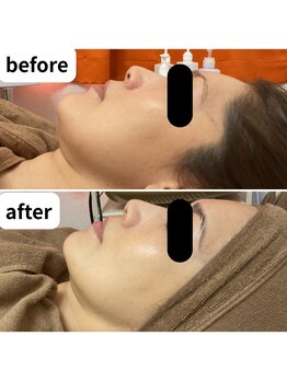 ブプラ 池田店(BUPURA)/艶肌☆ノーファンデ肌 肌質改善