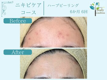 ボディコンディション/ハーブピーリング/毛穴洗浄/小顔